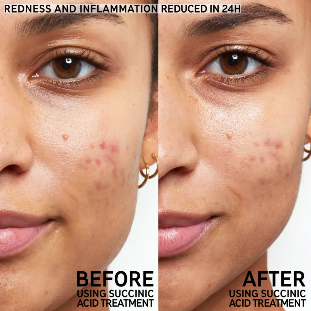 Succinic Acid Blemish Treatment (15ml)